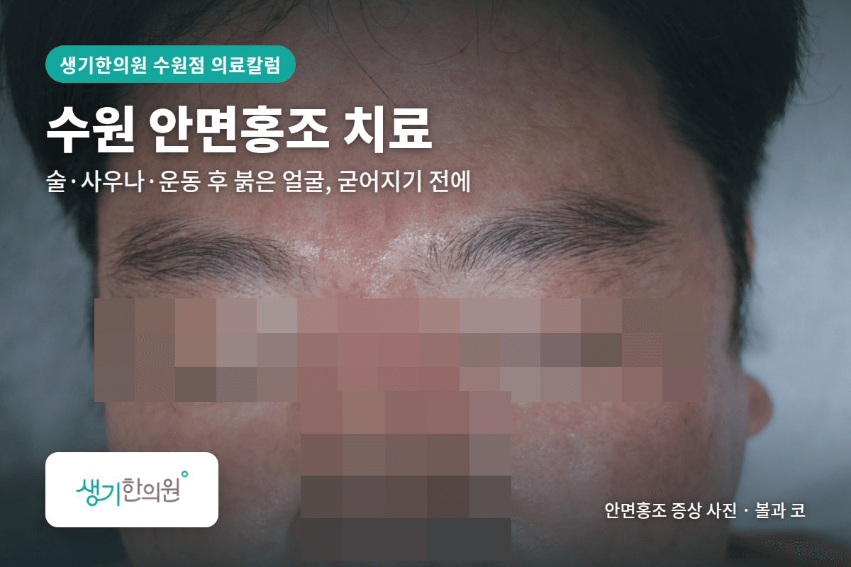 볼과 코 안면홍조 증상 사진과 문구 「수원 안면홍조 치료, 술·사우나·운동 후 붉은 얼굴, 굳어지기 전에 · 생기한의원 수원점」