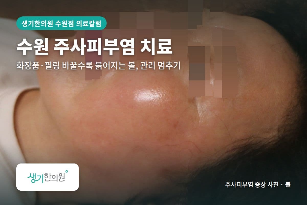 볼 주사피부염 증상 사진과 문구 「수원 주사피부염 치료, 화장품·필링 바꿀수록 붉어지는 볼, 관리 멈추기 · 생기한의원 수원점」