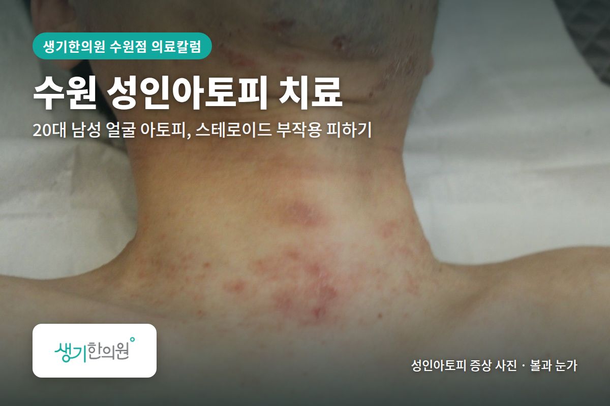 볼과 눈가 성인아토피 증상 사진과 문구 「수원 성인아토피 치료, 20대 남성 얼굴 아토피, 스테로이드 부작용 피하기 · 생기한의원 수원점」