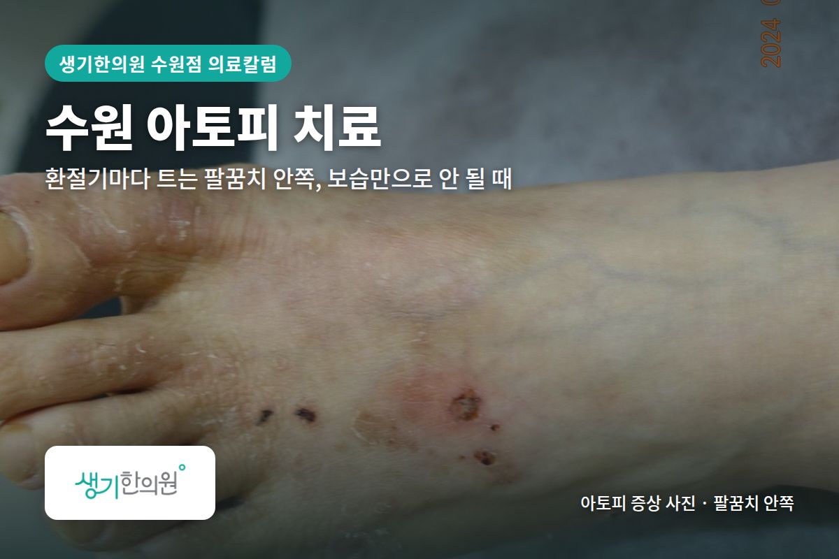 팔꿈치 안쪽 아토피 증상 사진과 문구 「수원 아토피 치료, 환절기마다 트는 팔꿈치 안쪽, 보습만으로 안 될 때 · 생기한의원 수원점」