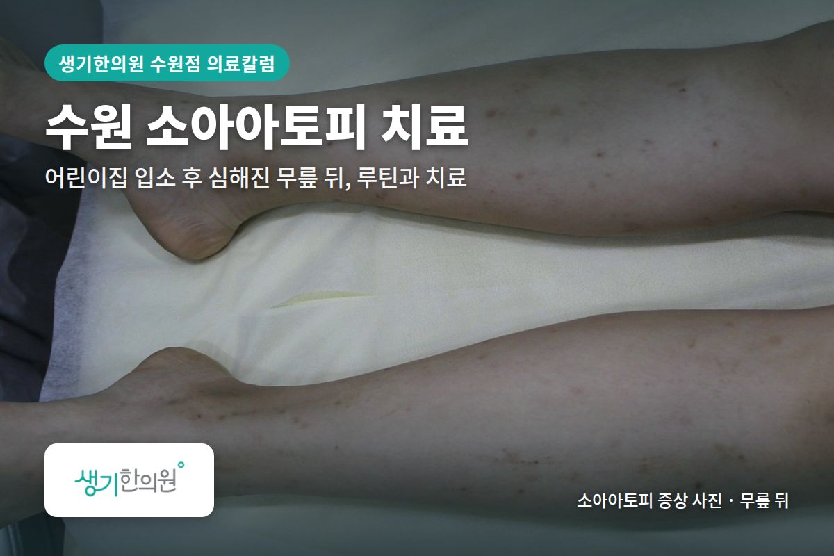 무릎 뒤 소아아토피 증상 사진과 문구 「수원 소아아토피 치료, 어린이집 입소 후 심해진 무릎 뒤, 루틴과 치료 · 생기한의원 수원점」