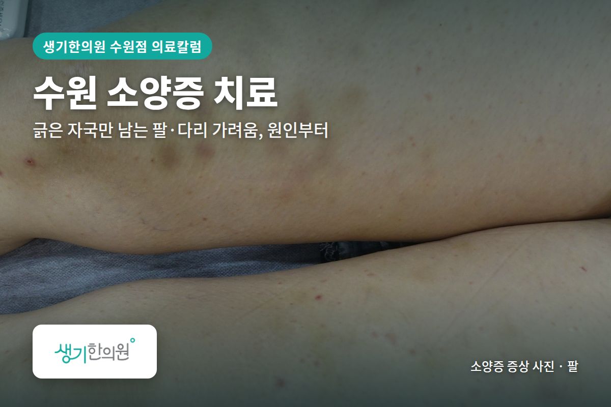 팔 소양증 증상 사진과 문구 「수원 소양증 치료, 긁은 자국만 남는 팔·다리 가려움, 원인부터 · 생기한의원 수원점」