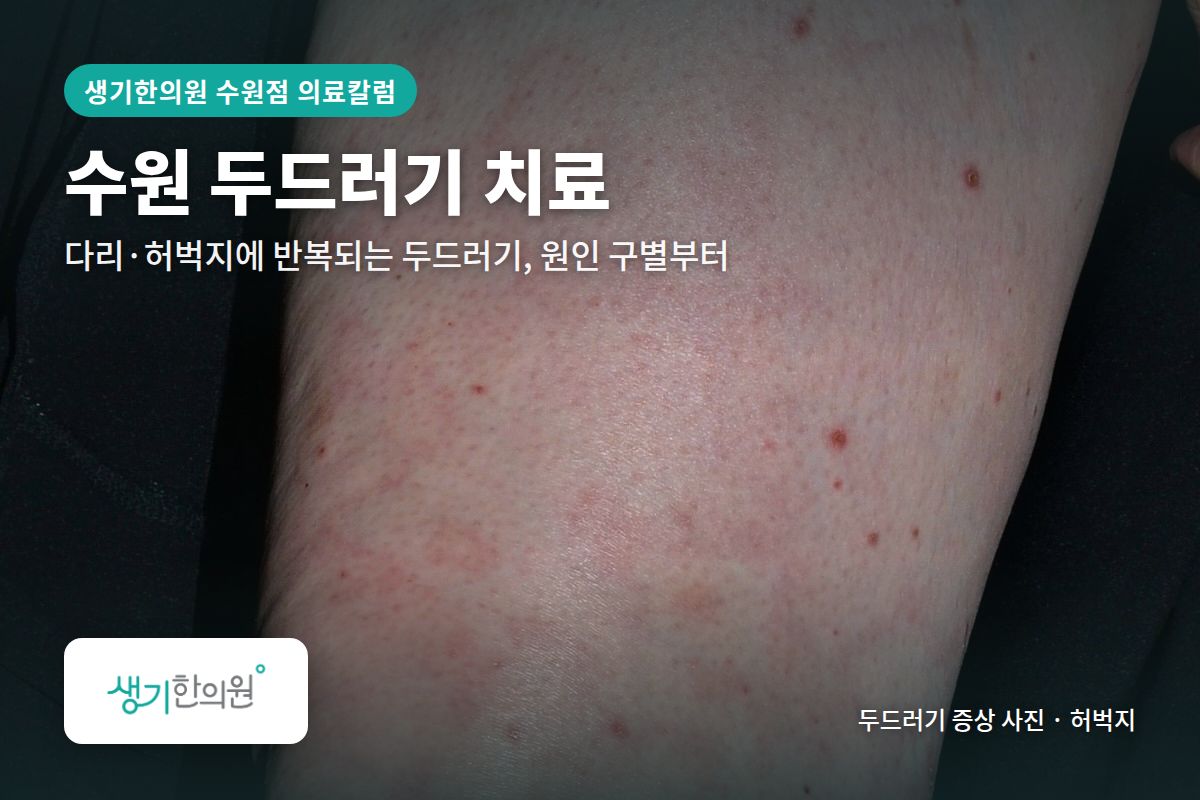 허벅지 두드러기 증상 사진과 문구 「수원 두드러기 치료, 다리·허벅지에 반복되는 두드러기, 원인 구별부터 · 생기한의원 수원점」